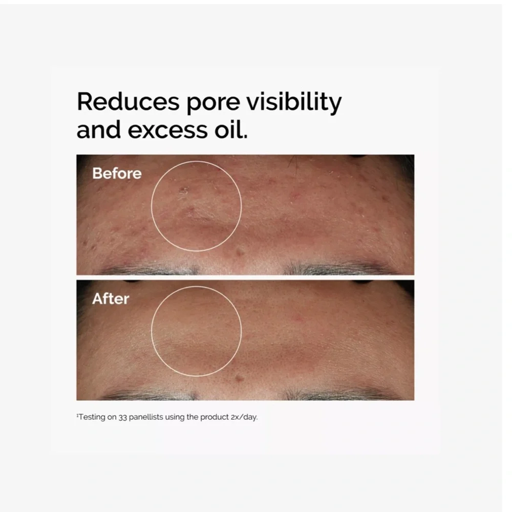 The Ordinary Niacinamide 10% + Zinc 1% Oil Control Serum 1oz NWT - Picture 3 of 6